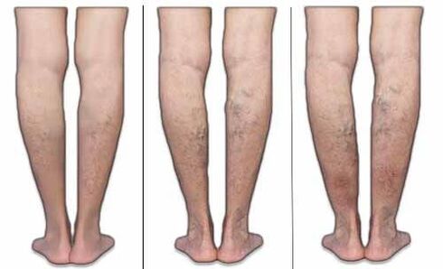 Varicose veins