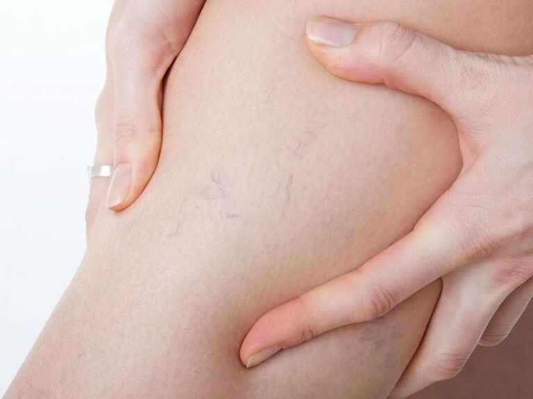 Varicose veins in the legs