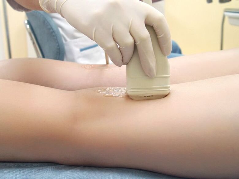 Varicose veins