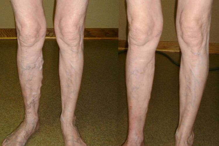 vein varicose veins in men
