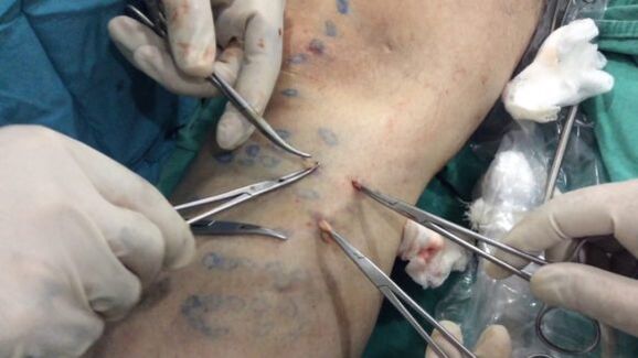 operation