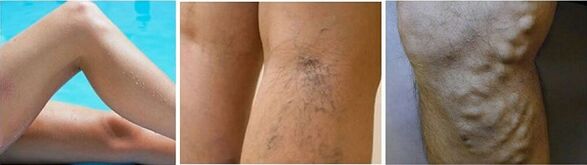The appearance of varicose veins in the legs