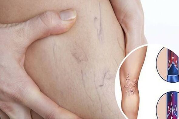 Photo of the varicose veins