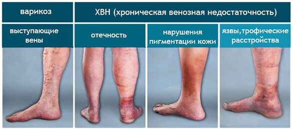 Varicose veins