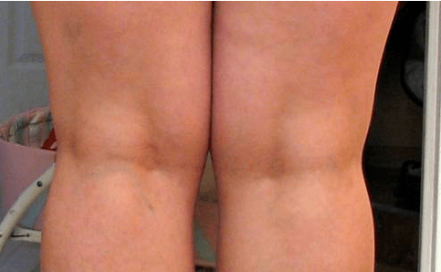 Vary in the legs