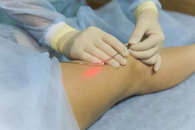 Treatment of veins with a laser