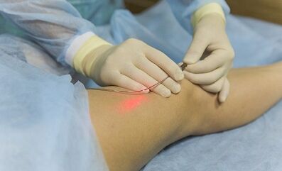 Treatment of veins with a laser