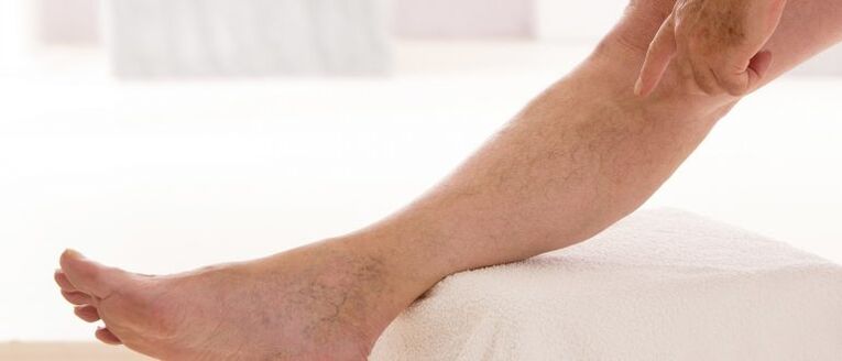 Varicose veins in the legs