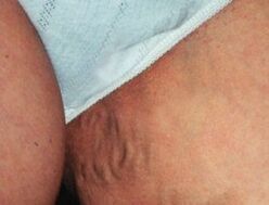 Varicose veins of the pelvis